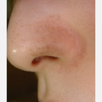 鼻孔の太田母斑