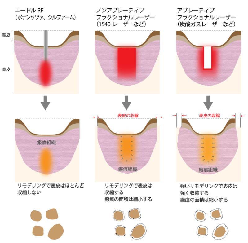 治療方法によってニキビ跡の面積の縮小効果が異なる説明図