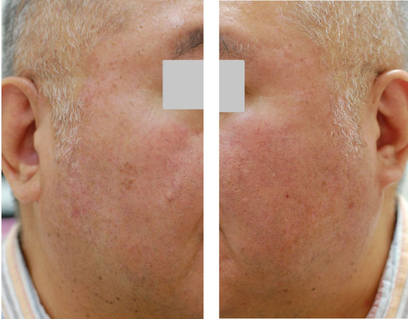 顔全体の脂漏性角化症のレーザー治療後の写真