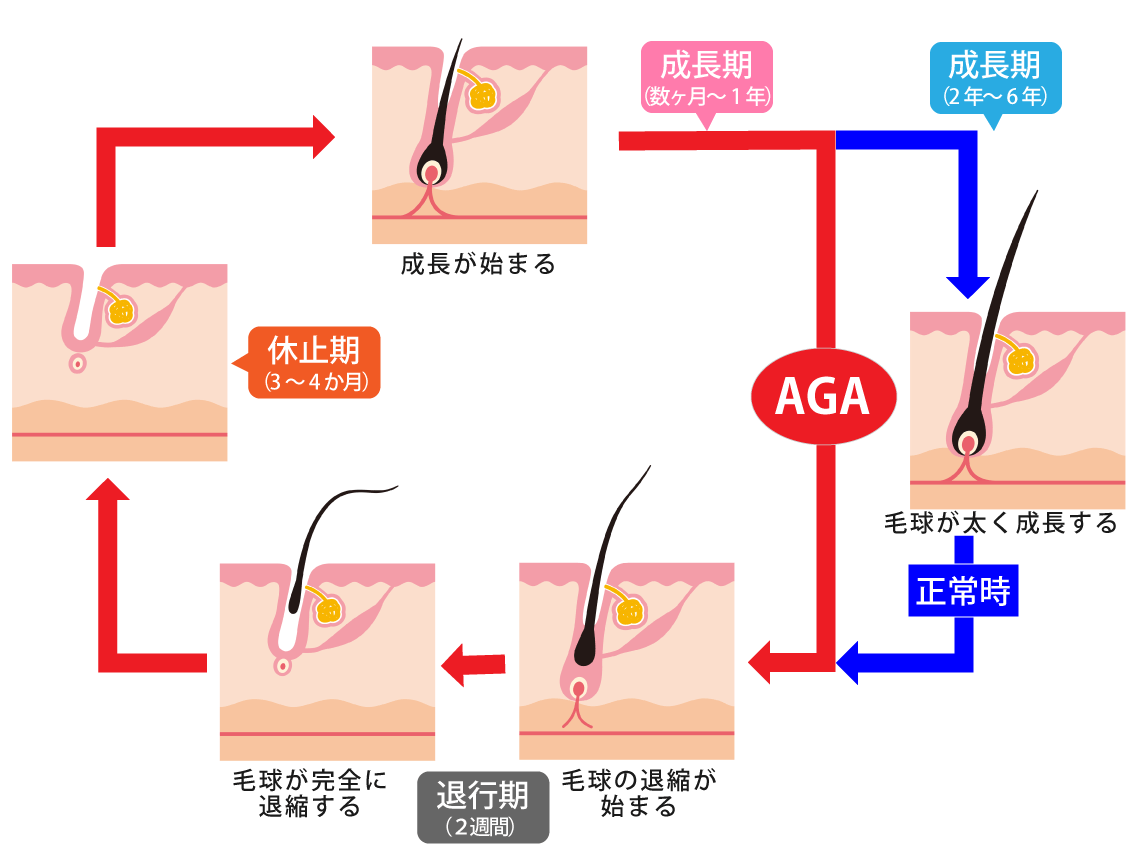 正常時とAGAのヘアサイクル