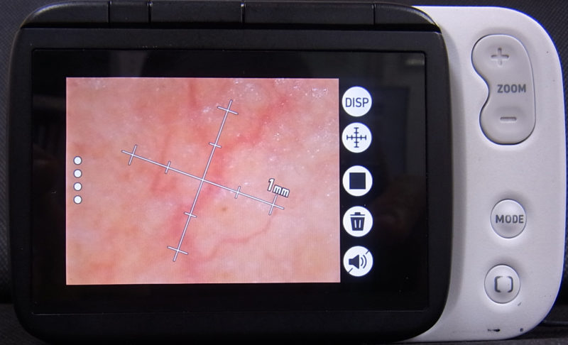 ダーモカメラでは撮影した毛細血管の拡張をその場で計測している写真
