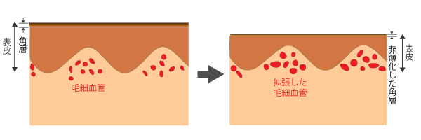 角層の菲薄化と血管の関係の模式図