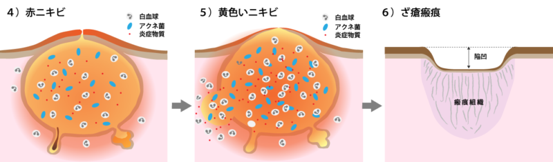 赤ニキビからざ瘡瘢跡を形成する過程図