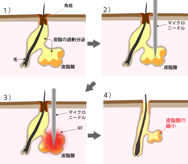 ポテンツァによる皮脂腺への熱作用の図