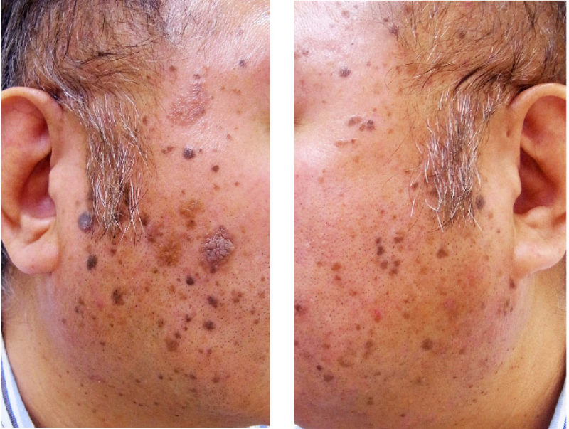 顔全体の脂漏性角化症のレーザー治療前の写真