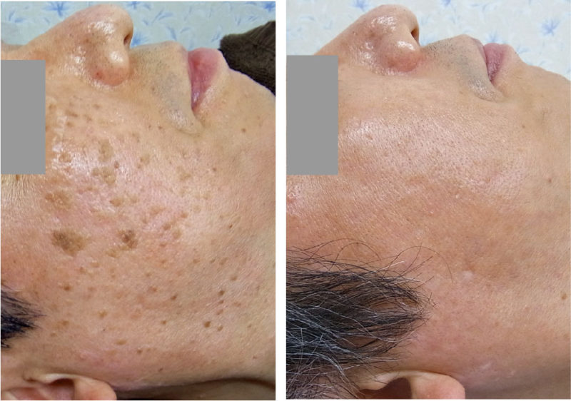 顔面の右半分の脂漏性角化症の治療後の写真