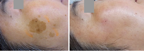 右頬部の脂漏性角化症のレーザー治療前後の写真