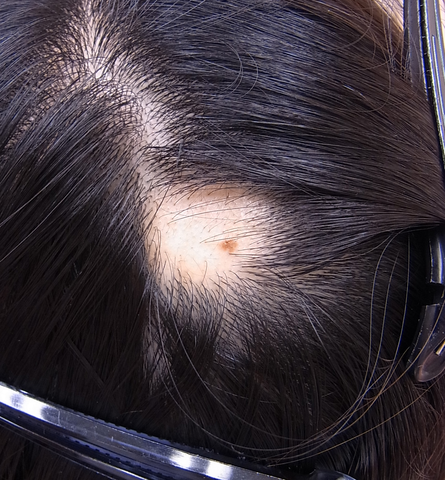 症 円形 治療 脱毛 産毛が生えたら円形脱毛症は治る？回復までの3ステップを知ろう！