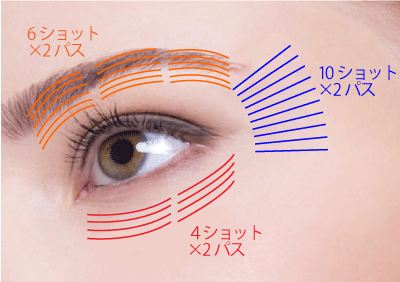 眼の周囲の照射の図