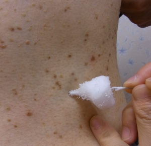イボ除去に使われる綿棒による液体窒素冷凍療法の写真