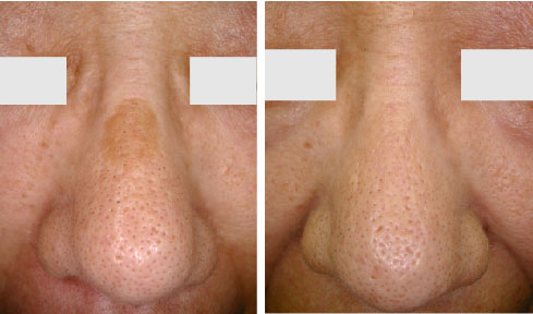 鼻背の脂漏性角化症のレーザー治療前後の写真