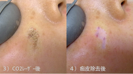 脂漏性角化症レーザー治療後に痂皮をふき取った状態の写真