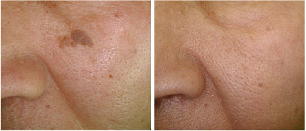 頬部の脂漏性角化症のレーザー治療前後の写真