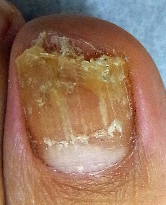 爪 白癬 菌 糖尿病は爪白癬を引き起こす！最悪の場合、足が壊死します
