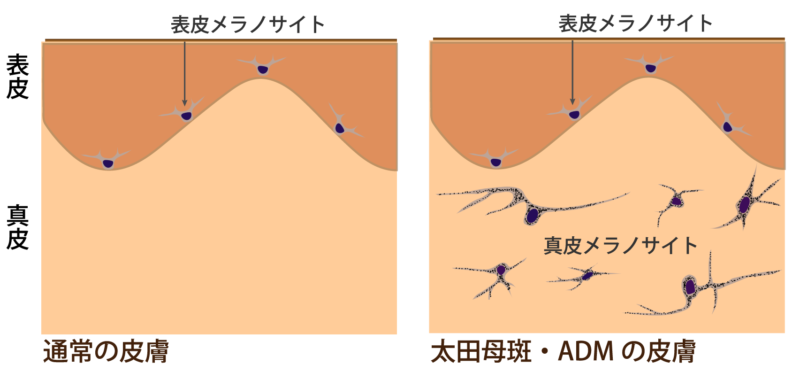 太田母斑　ADMの組織像
