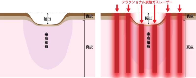 にきび瘢痕コア治療