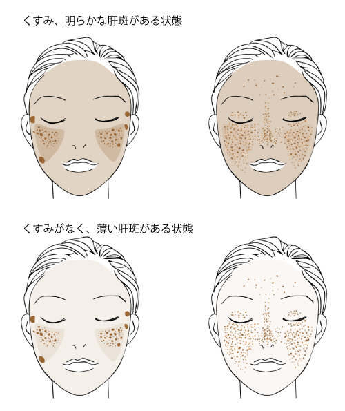 シミ・そばかすのレーザー治療ではくすみのない状態でおこなうのがよい治療結果をもたらすコツとなります。