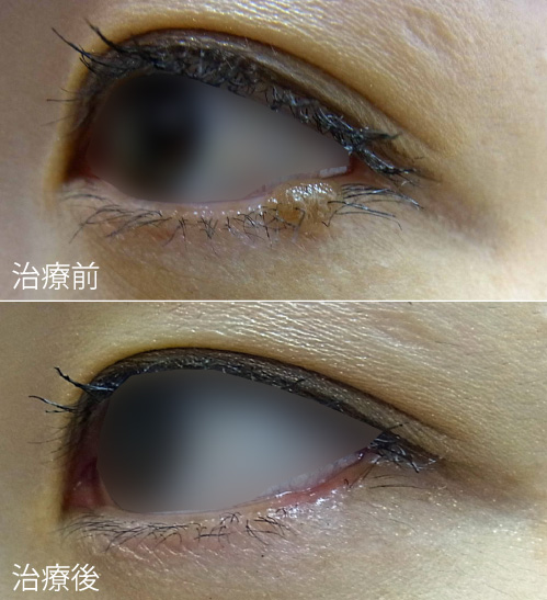 症例5の治療前後の写真