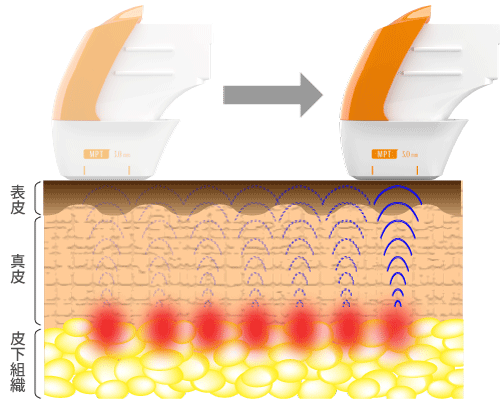 ウルトラフォーマーMPTのドットモード