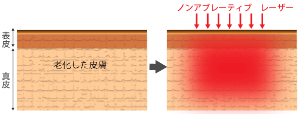 ノンアブレーティブレーザーの作用機序