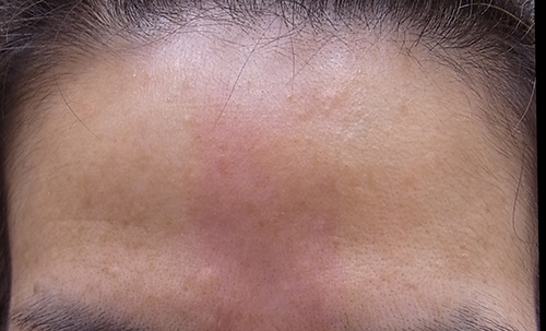 サーモンパッチの写真