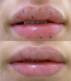 口唇ホクロ写真