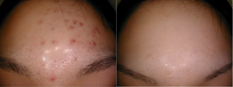 症例１治療前後写真