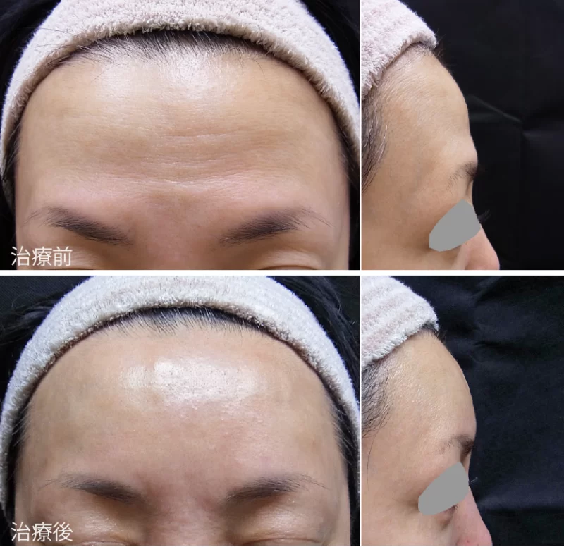 側頭部の前額にヒアルロン酸注入