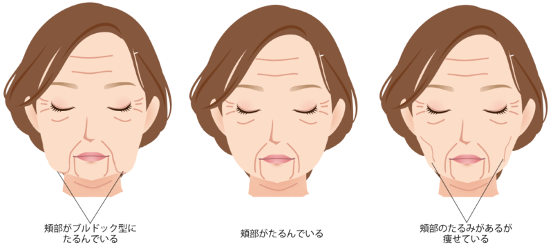 顏のたるみのタイプ分類