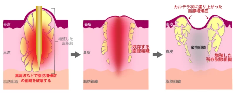 高周波治療でカルデラ状の再発がおこるメカニズム