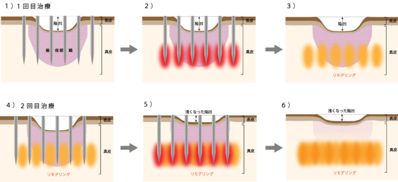 ニードルRF、ポテンッツァとシルファームでの皮膚のリモデリングのメカニズム.