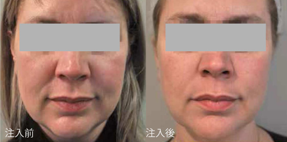 プロファイロ施術前後写真