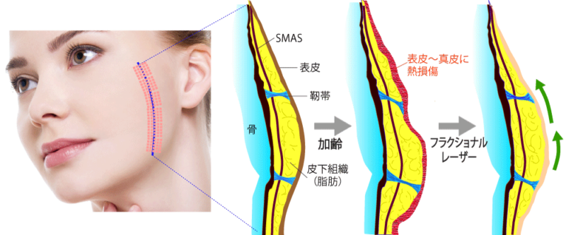 フラクショナルレーザーのリフトアップのメカニズム