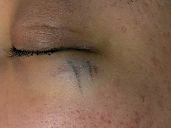外傷性刺青の写真(下眼瞼)