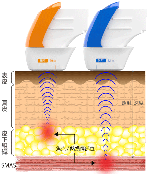 焦点距離と照射深度