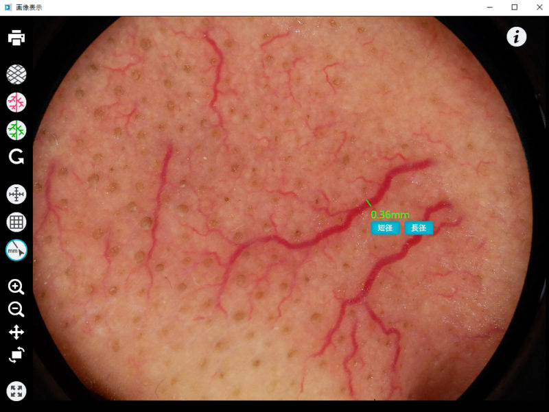 ダーモカメラ　DZ-D100での血管の直径の計測写真