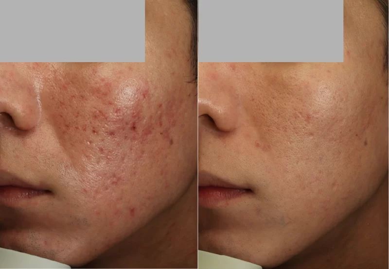 ニキビ痕ポテンツァ治療前後写真