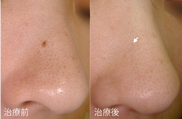 症例3の治療前後の写真