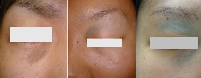 目の下のクマのようにみえるADM