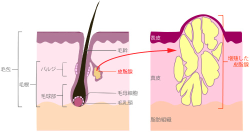 脂腺増殖症のイラスト