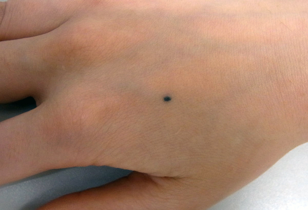 外傷性刺青の写真(手背)