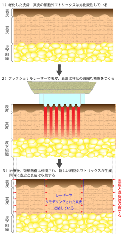 1540フラクショナルレーザーでの表皮、真皮の変化