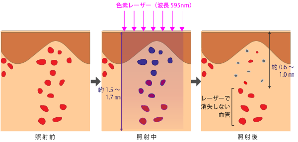 Vビームでの治療の限界