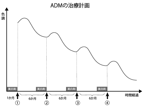 ADMのレーザー治療計画のイラスト