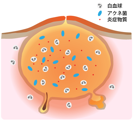 赤ニキビの状態