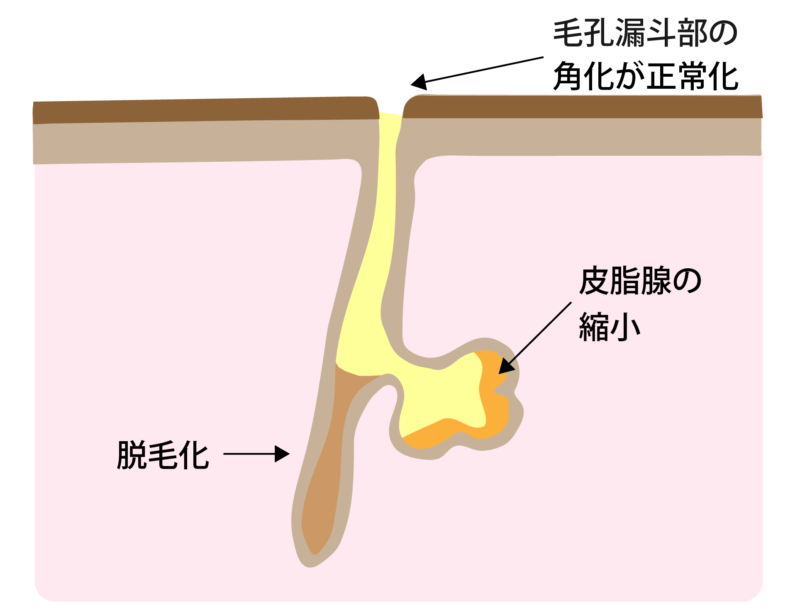 レーザーフェイシャルの作用機序3