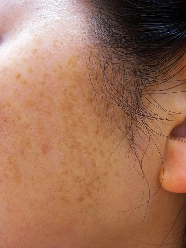 扁平母斑の写真（顏）