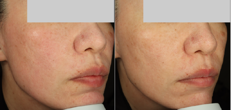 ポテンツァ治療前後