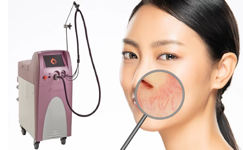 アイキャッチ画像毛細血管拡張症