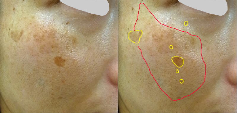 肝斑とシミの区別